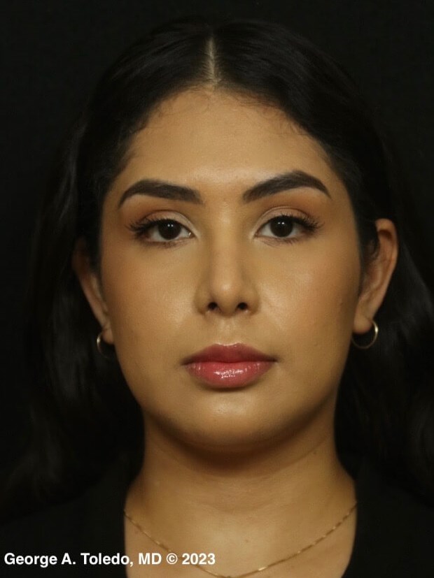 Rhinoplasty Before and After After