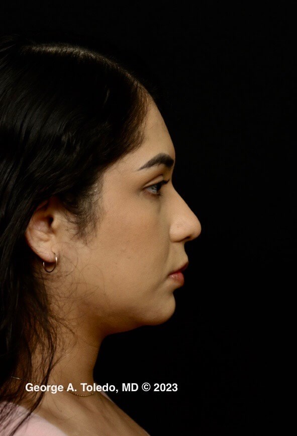 Rhinoplasty Before and After Before