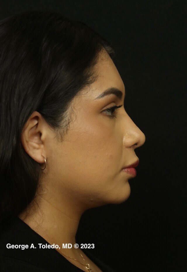 Rhinoplasty Before and After After
