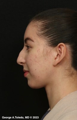Rhinoplasty Before and After Before