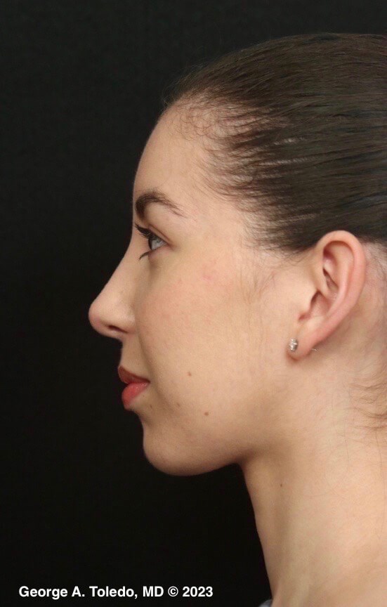 Rhinoplasty Before and After After