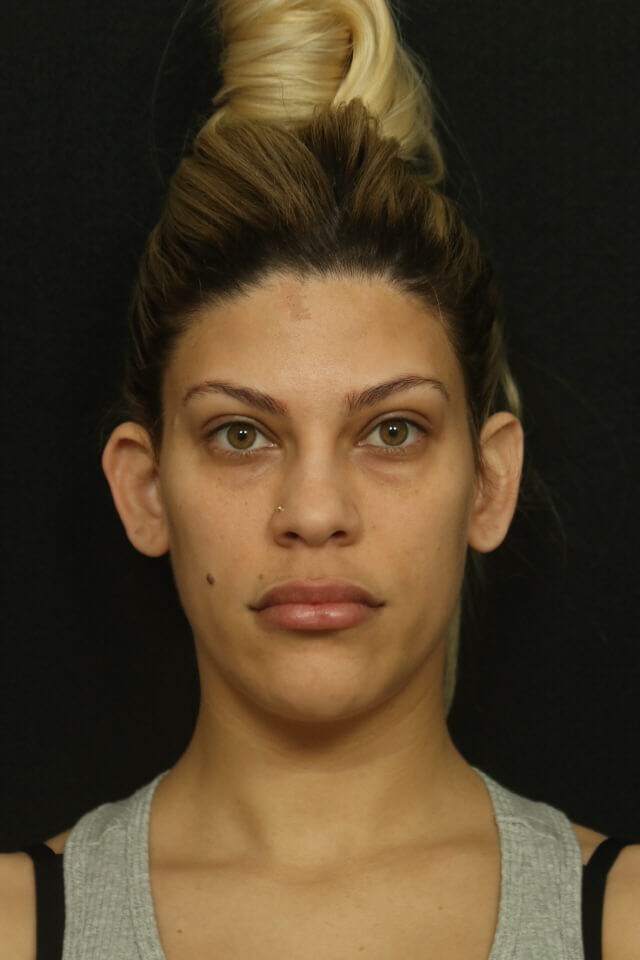 Otoplasty Before and After Before