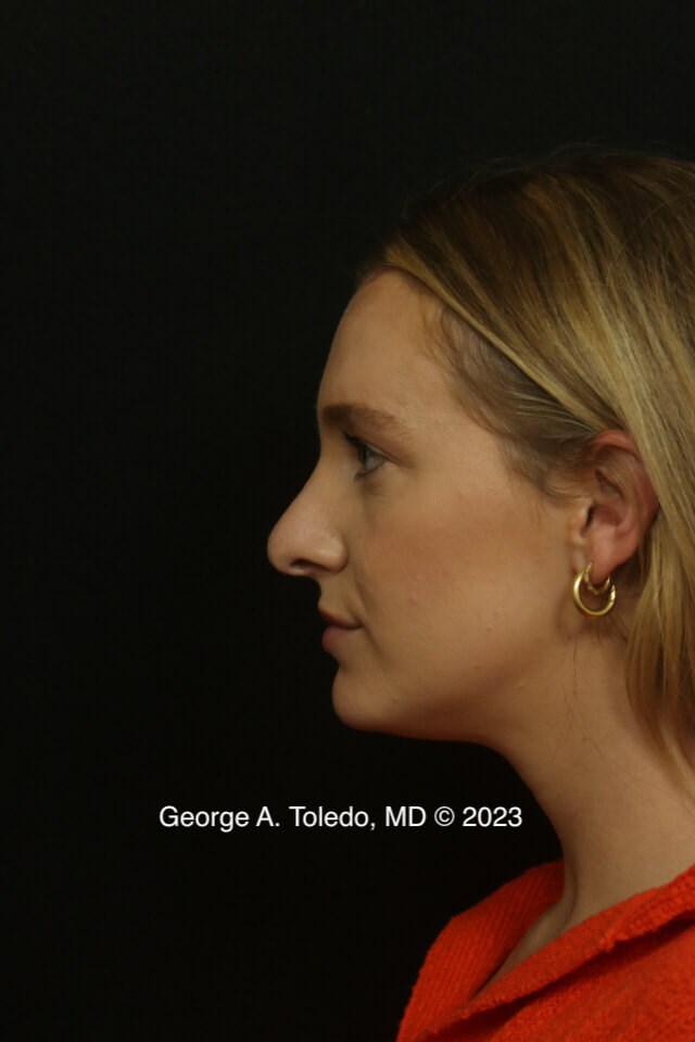Rhinoplasty Before and After Before