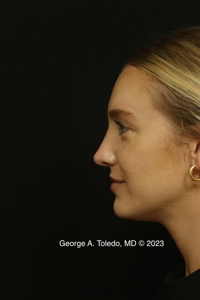 Rhinoplasty Before and After After