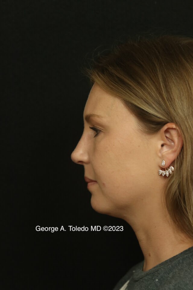 Rhinoplasty Before and After After