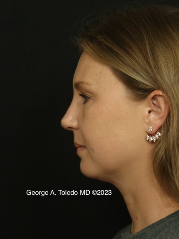 Rhinoplasty Before and After After