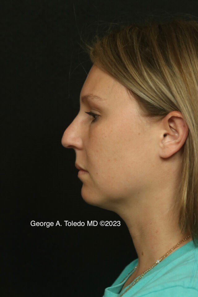 Rhinoplasty Before and After Before