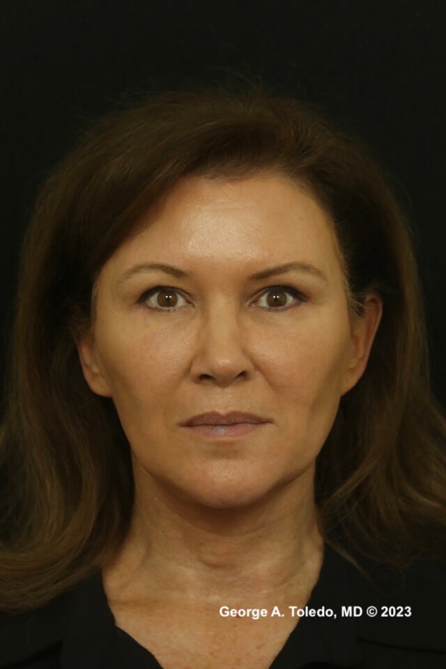 Facelift Rhinoplasty Photos After