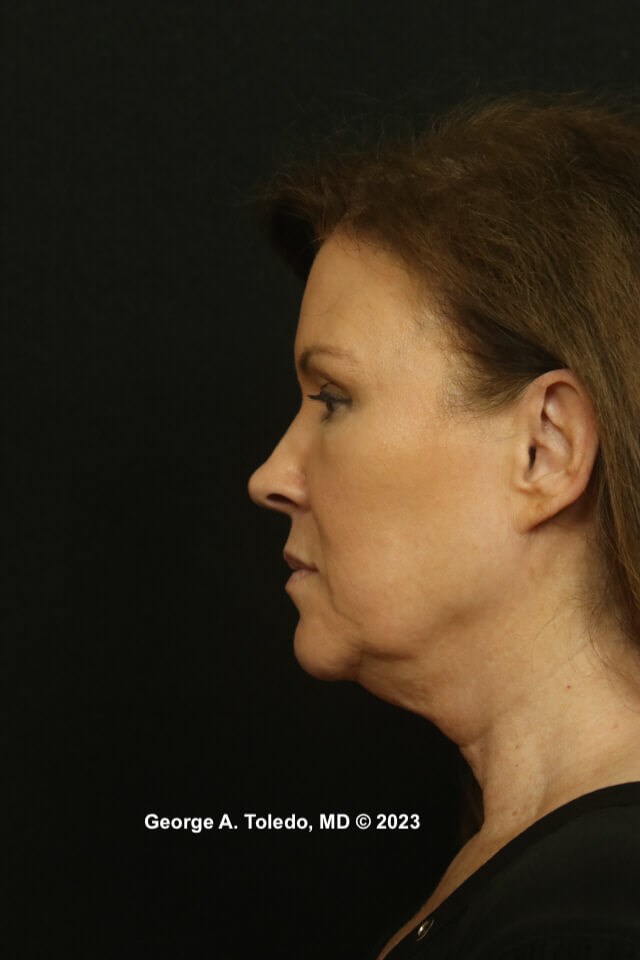 Facelift Rhinoplasty Photos Before