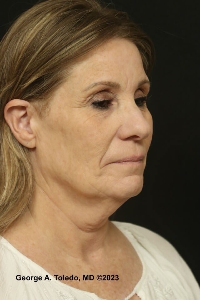 Face Neck Lift, Rhinoplasty Before