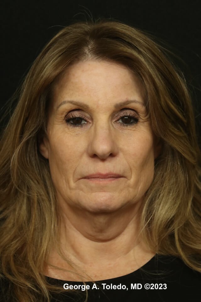 Face Neck Lift, Rhinoplasty Before