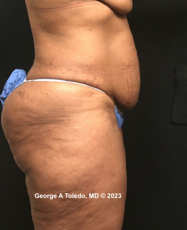Tummy Tuck Before and After Before