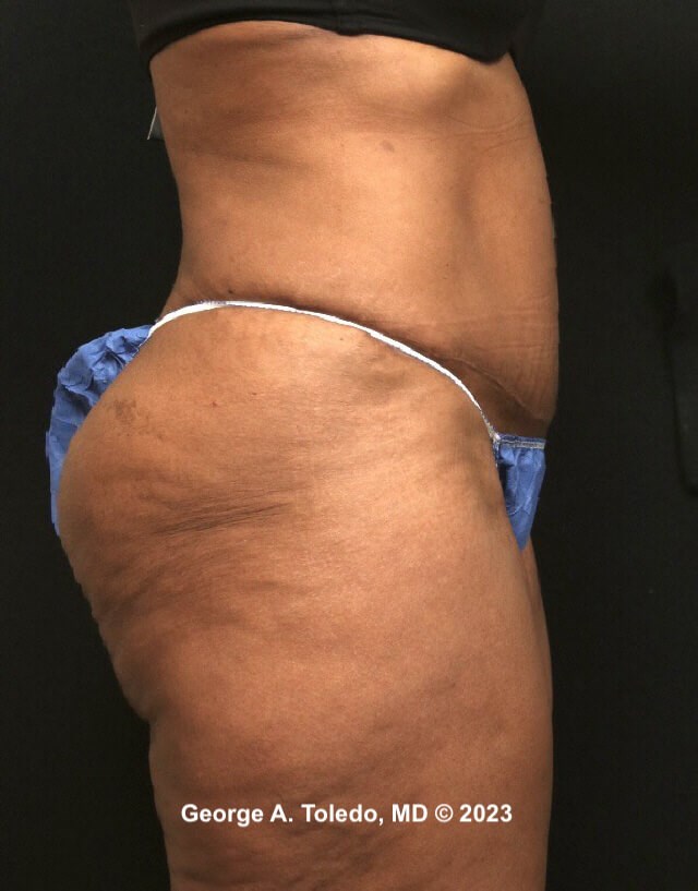 Tummy Tuck Before and After After