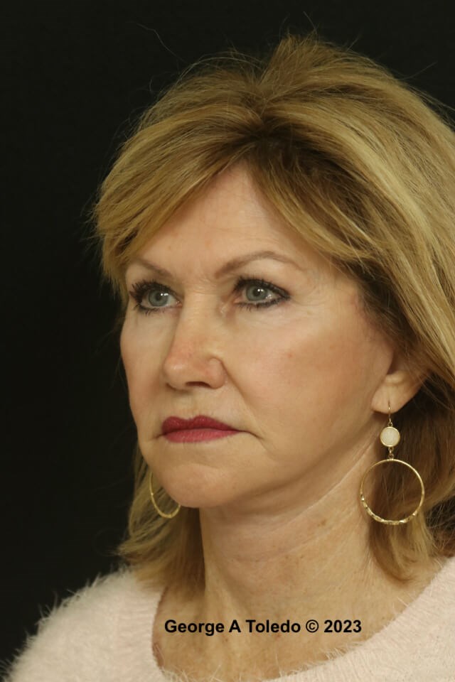 Facial Rejuvenation Photos After