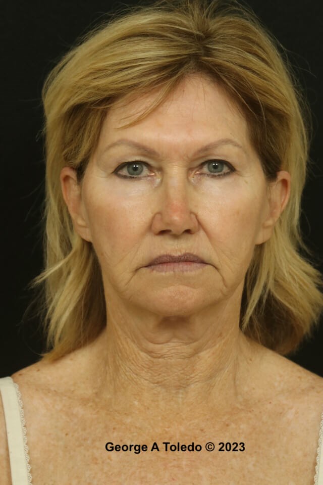 Facial Rejuvenation Photos Before
