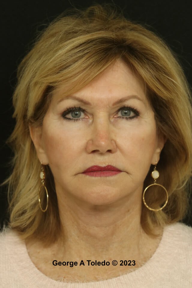 Facial Rejuvenation Photos After