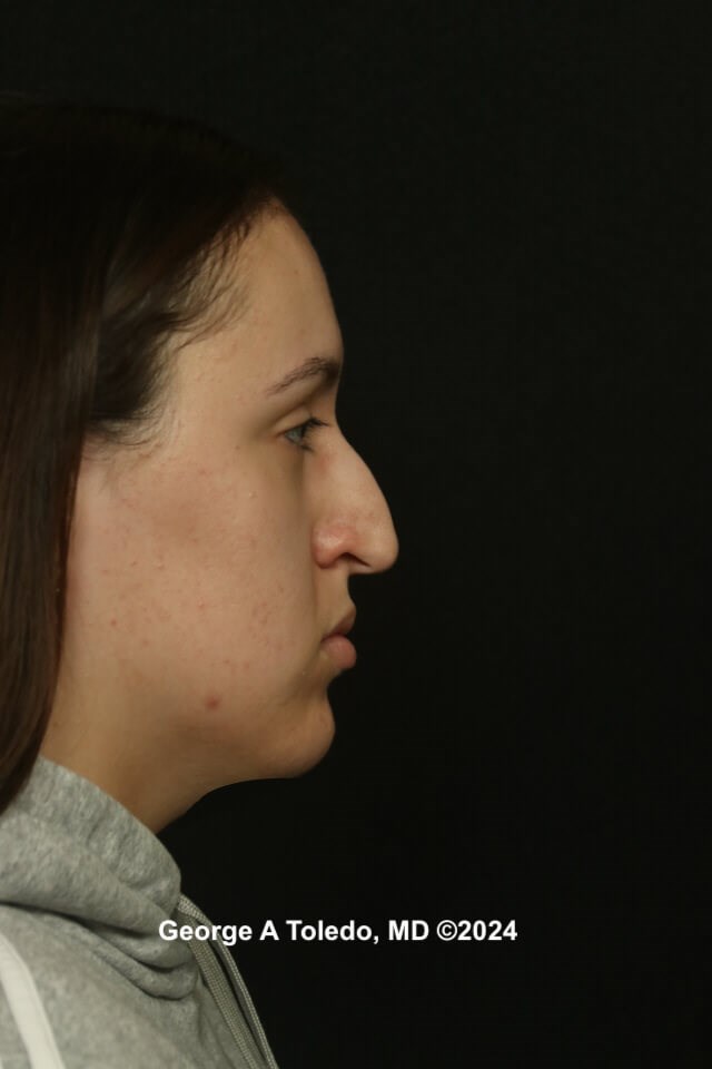 Rhinoplasty Before and After Before