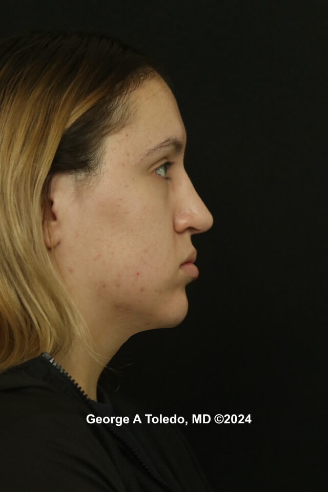 Rhinoplasty Before and After After