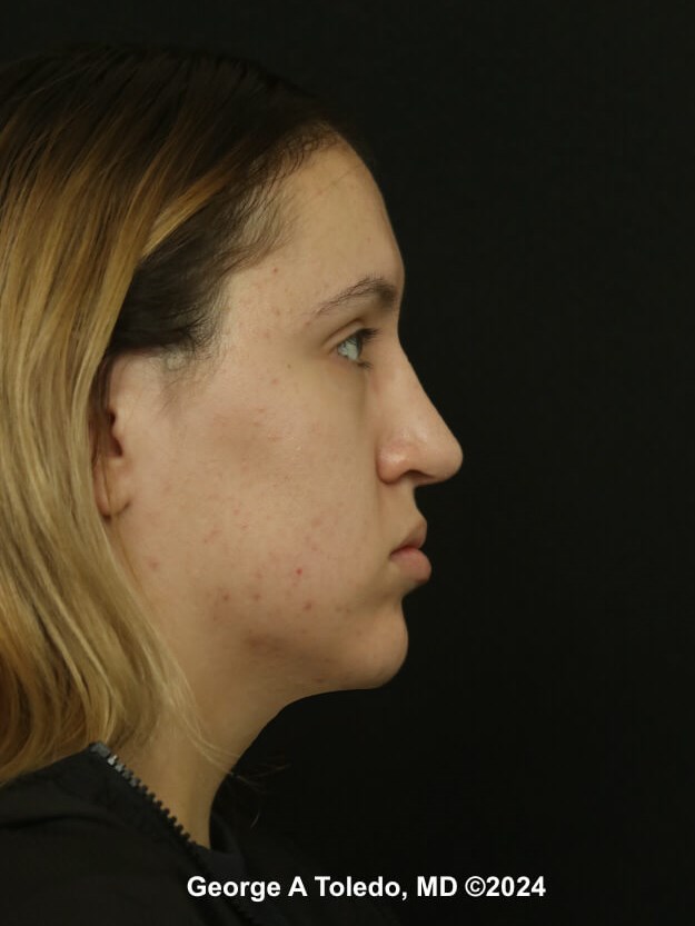 Rhinoplasty Before and After After