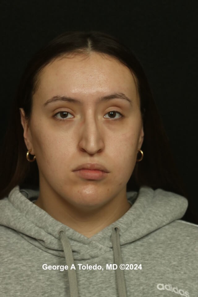 Rhinoplasty Before and After Before