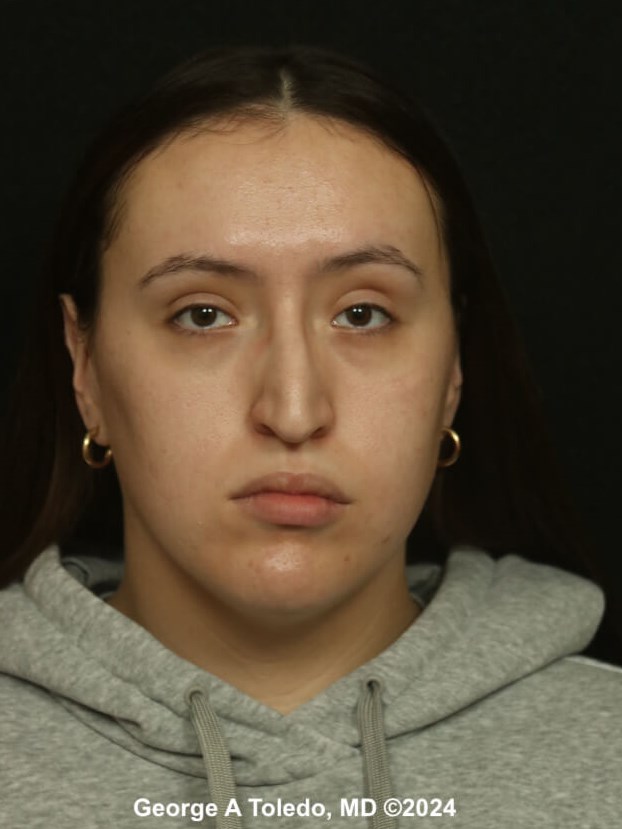 Rhinoplasty Before and After Before