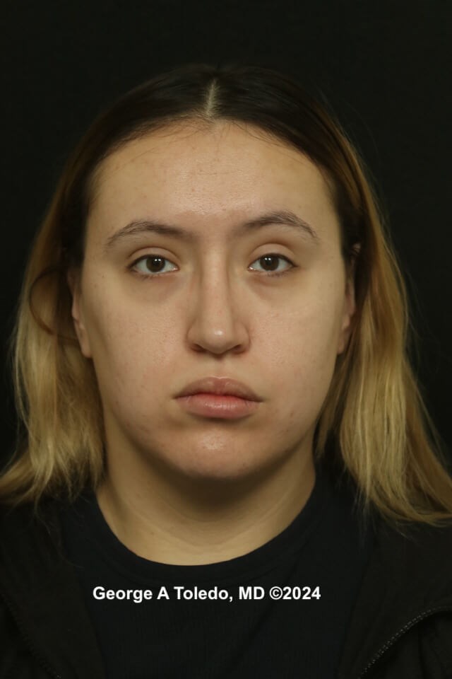 Rhinoplasty Before and After After