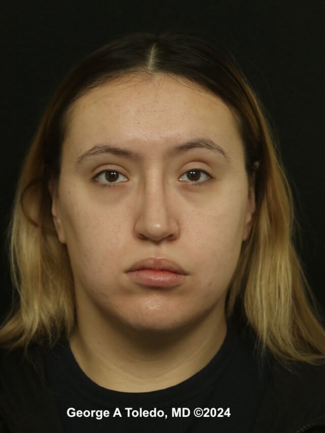 Rhinoplasty Before and After After