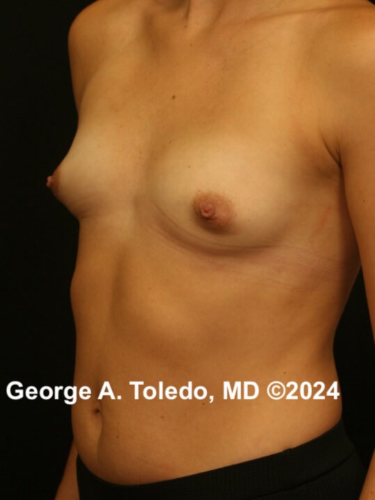 Breast Augmentation Before