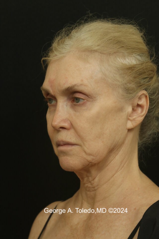 Facelift Before and After Before