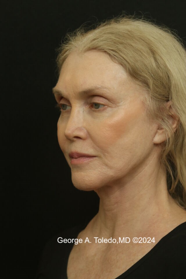 Facelift Before and After After