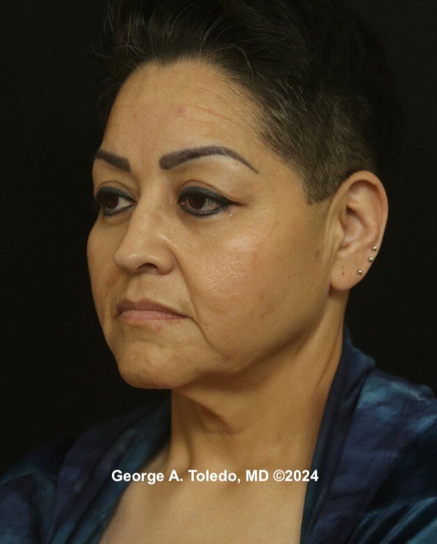 Facelift Before and After Before