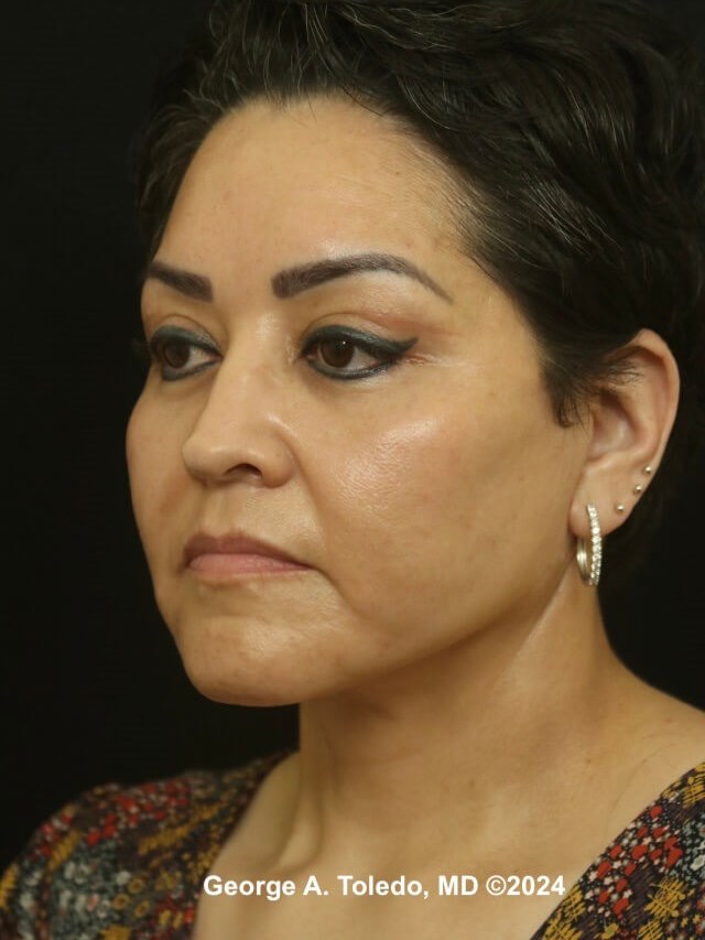 Facelift Before and After After