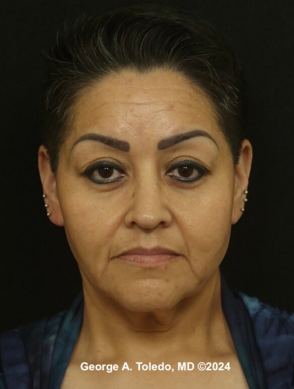 Facelift Before and After Before