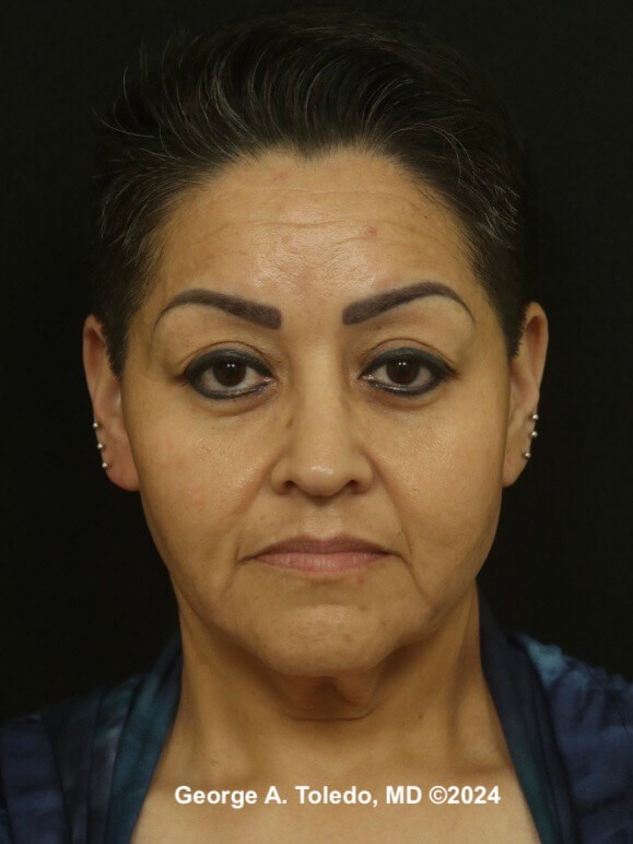 Facelift Before and After Before