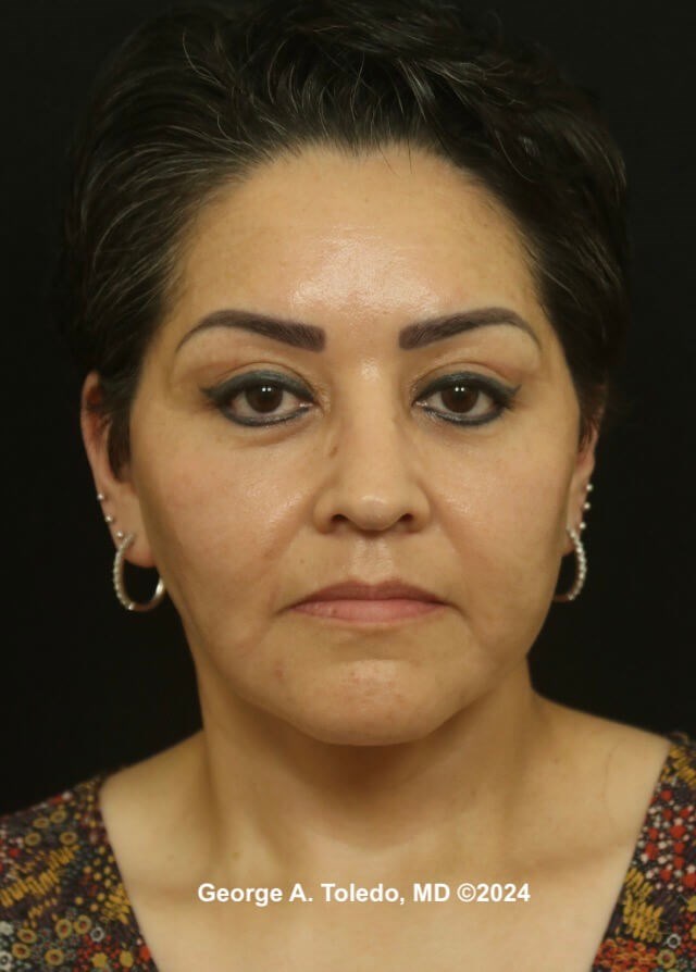 Facelift Before and After After