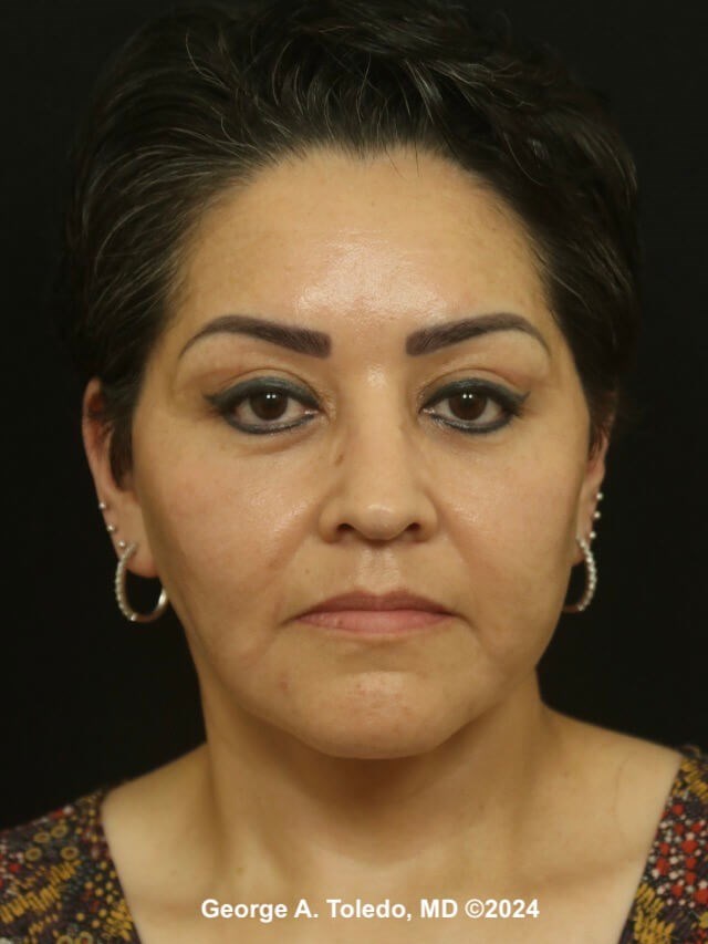 Facelift Before and After After