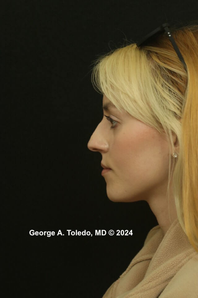 Rhinoplasty Before and After Before