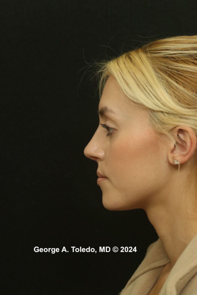 Rhinoplasty Before and After After