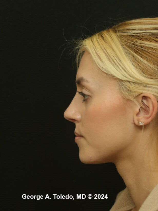 Rhinoplasty Before and After After