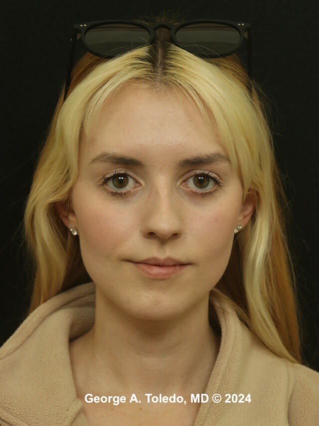 Rhinoplasty Before and After Before