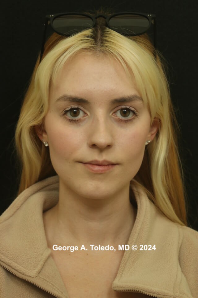 Rhinoplasty Before and After Before