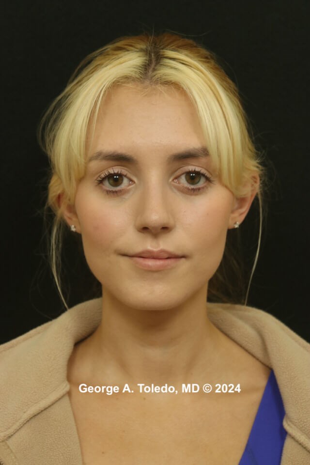 Rhinoplasty Before and After After
