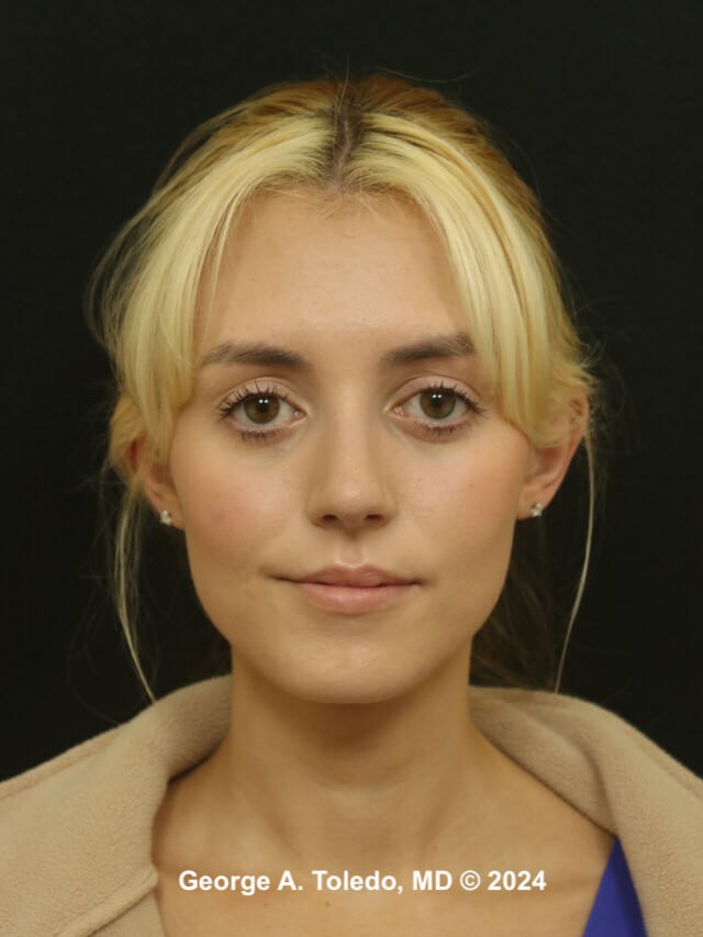 Rhinoplasty Before and After After