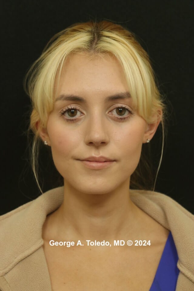 Rhinoplasty Before and After After