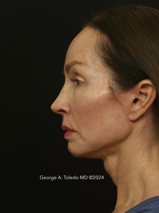 Facelift and Rhinoplasty After