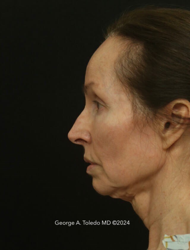Facelift and Rhinoplasty Before