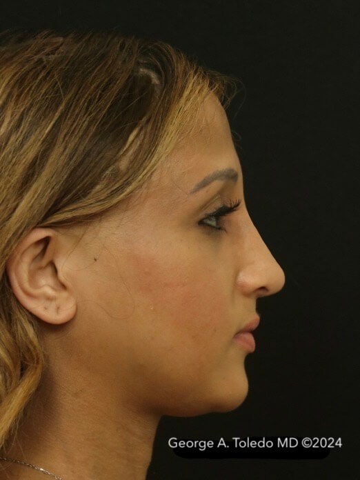 Rhinoplasty Before And After After
