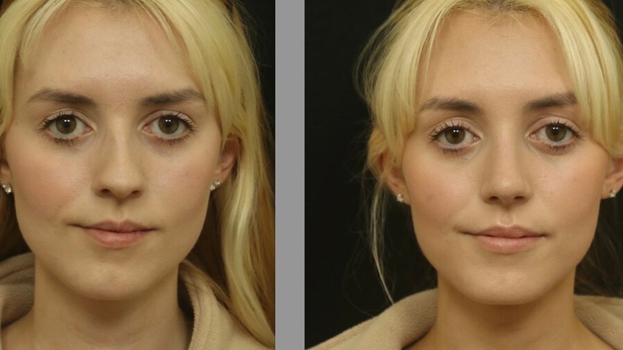 Beautiful Rhinoplasty Results