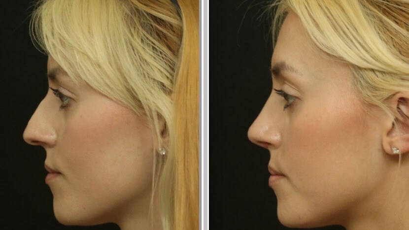 Beautiful Rhinoplasty Results