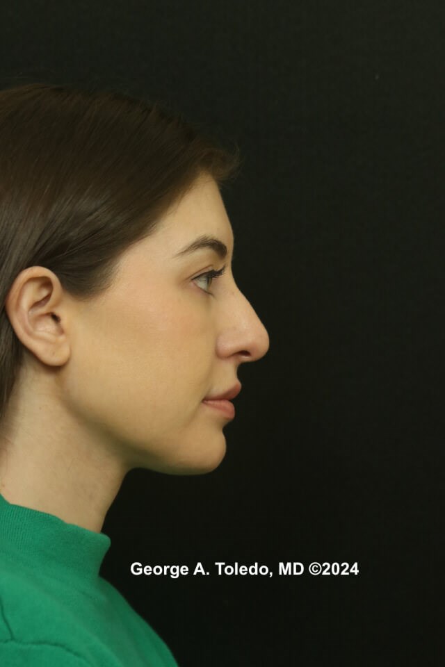 Rhinoplasty Before and After Before